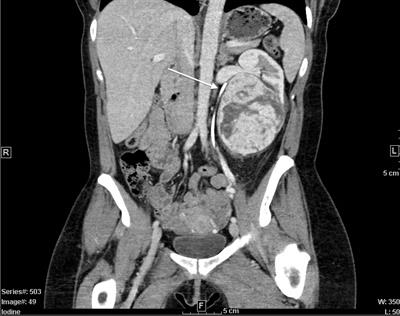 Case report: Important considerations for a renal mass on a solitary kidney in an adult with history of childhood wilms tumor